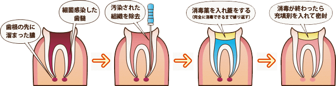 根管治療の手順